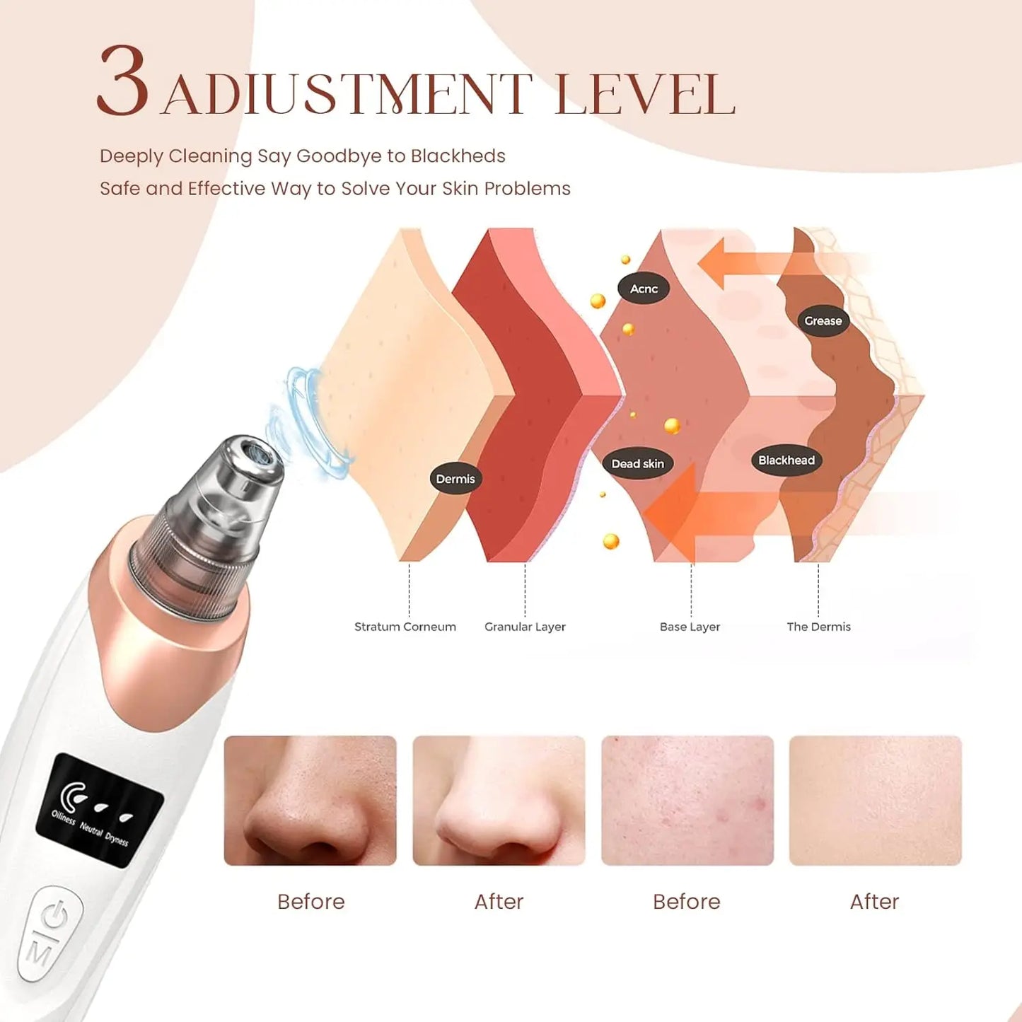 Blackhead Remover Vacuum